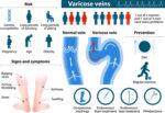 varicose veins infographic