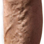 varicose veins